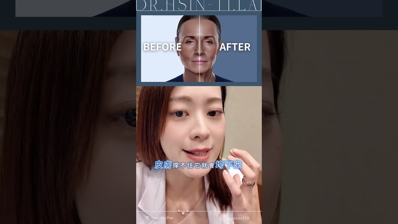 猛健樂瘦太快!小心臉先崩壞!!#整外女醫賴昕隄 縮圖
