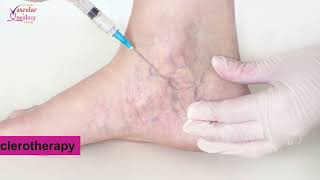 Spider veins and Varicose veins के बीच अंतर | Dr Kaurabhi Zade - Vascular and Oncology Clinic