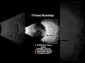 B Scan report in eye practice #shorts #viral #reels #optometry #doctor