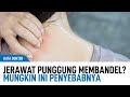 Jerawat Punggung Hitam: Musuh Kebersihan dan Penampilan