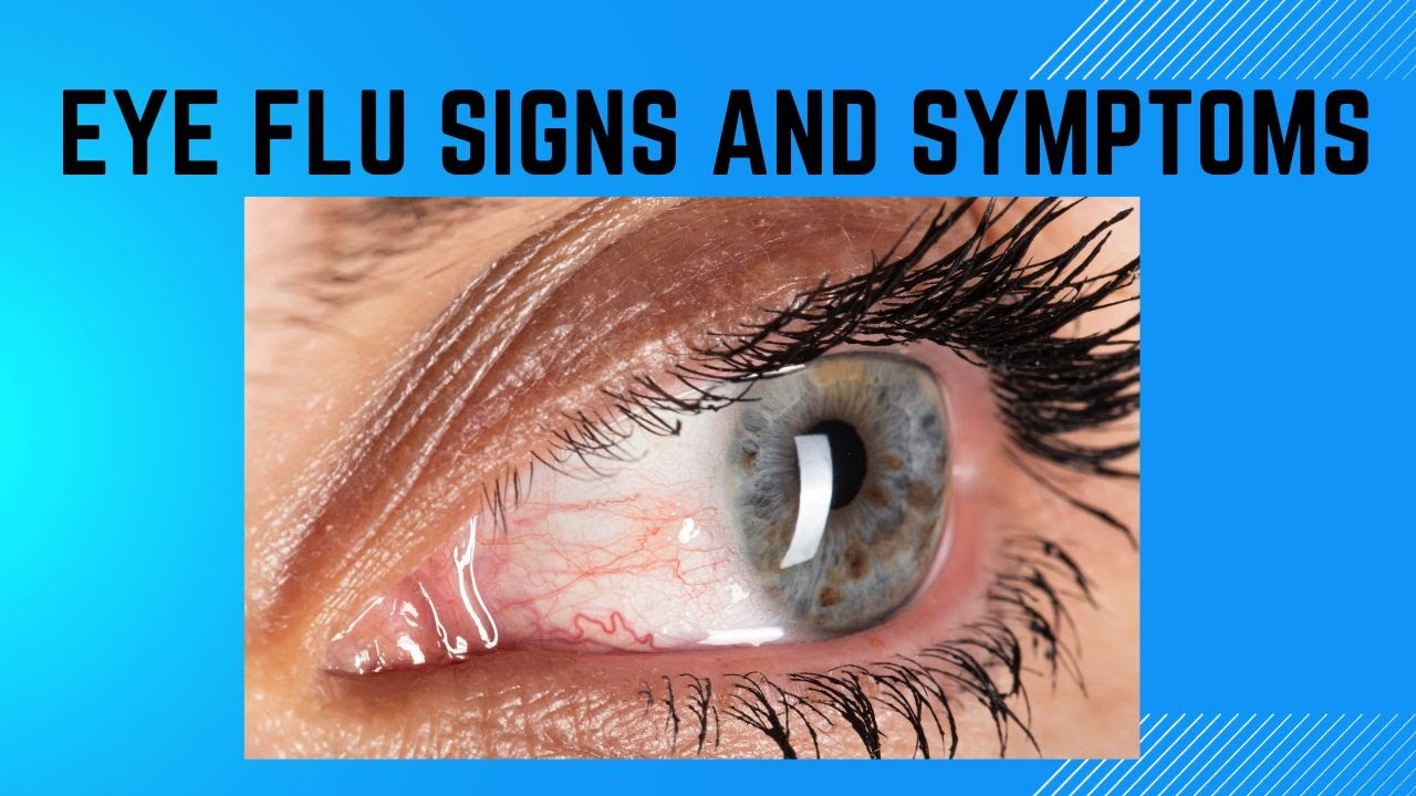 EYE FLU Signs And Symptoms YouTube eye-flu-signs-and-symptoms-youtube