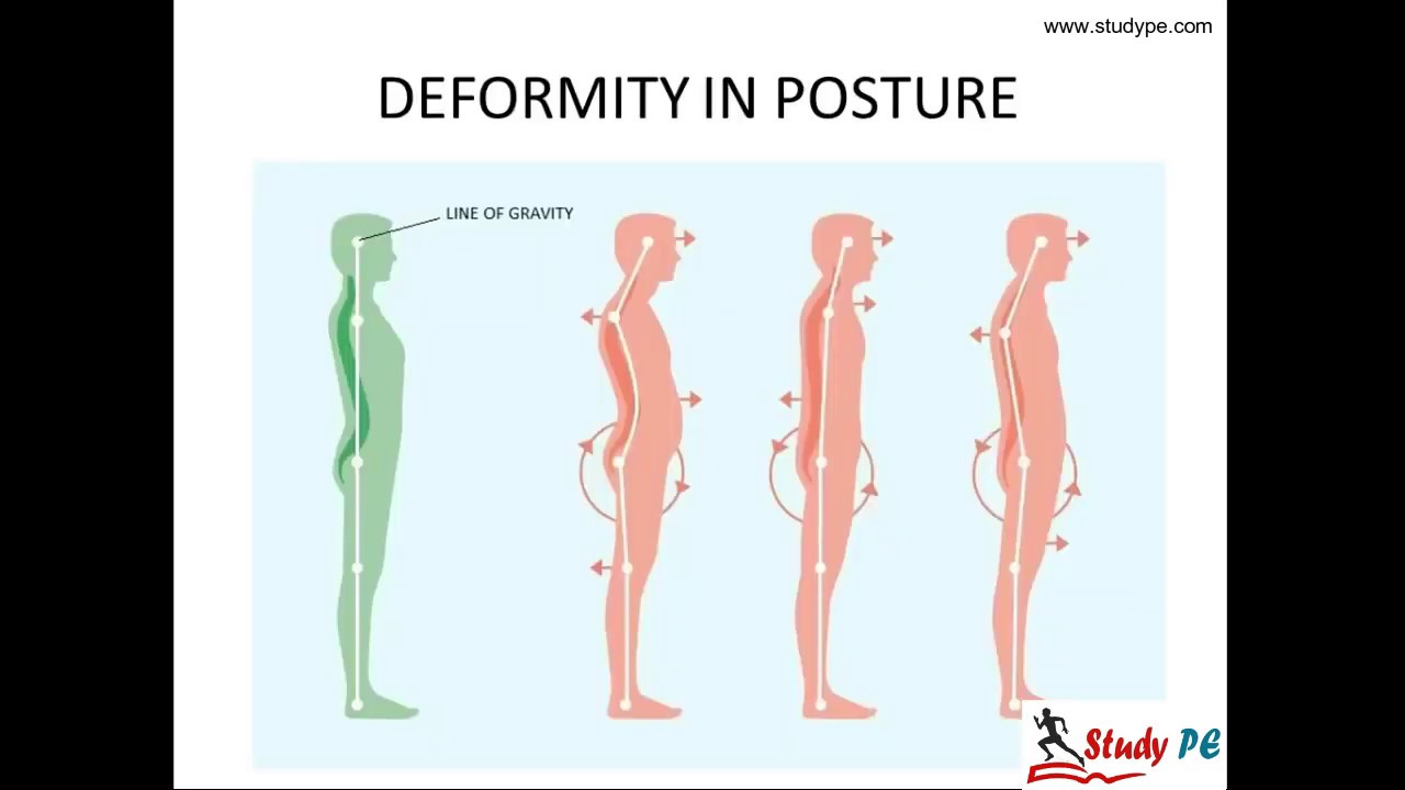 Posture And Its Deformities YouTube Posture And Its Deformities YouTube