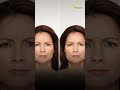 Which Botox Filler Brand Is Best ?