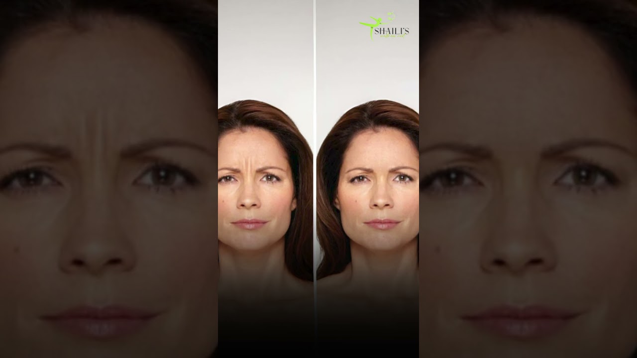 Which Botox Filler Brand Is Best ?