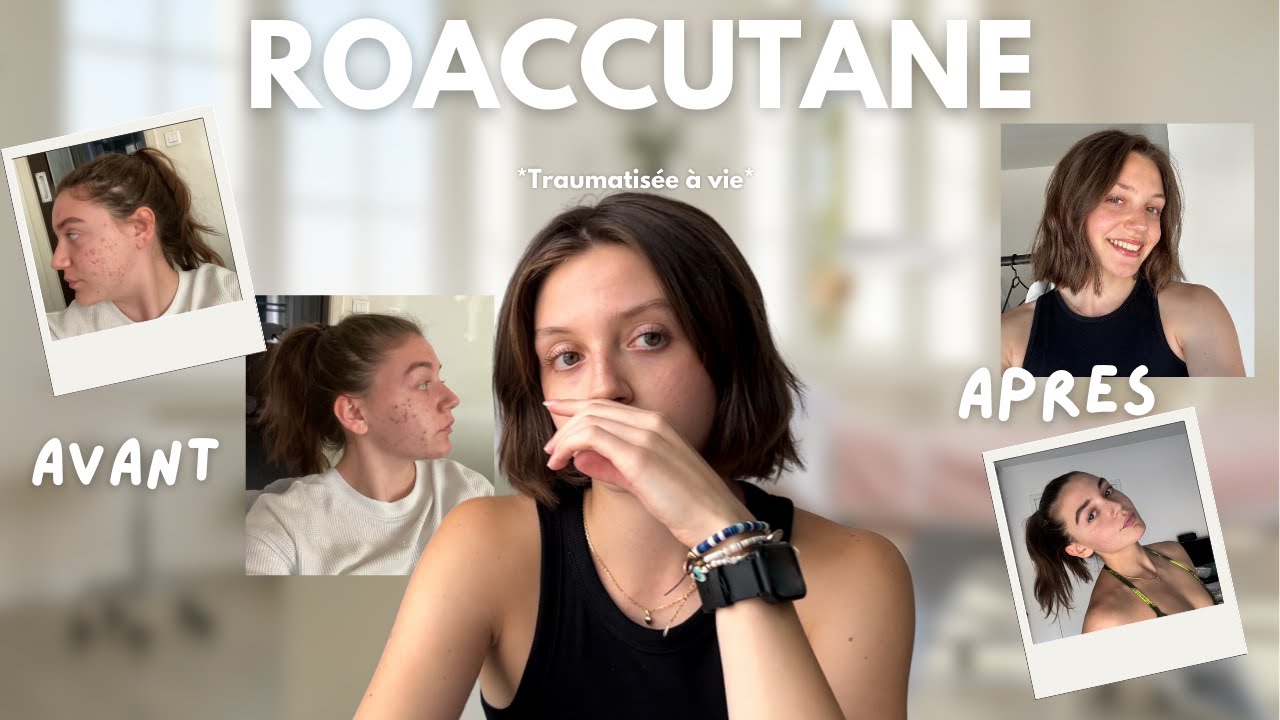 Roaccutane ‐ Ce traitement a changé ma vie !  (et pas qu'en bien...)