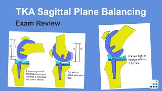 TKA Sagittal Plane Balancing Exam Review - Ron Delanois, MD