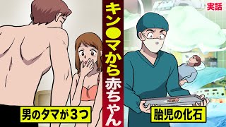 【実話】キン●マから赤ちゃんが出てきた男。男のタマが３つ...胎児の化石だった。