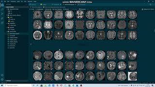 Brain Tumor Classification using Deep learning