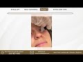Sunshine Lift - Facelift - Neck Lift - Eyelid Lift - Skin Type Treatment Options - Neogen Plasma