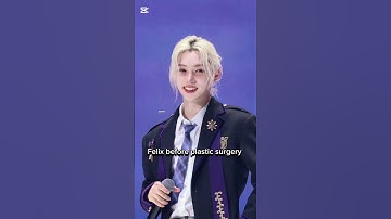 Felix before plastic surgery vs after plastic surgery #leefelix #felix