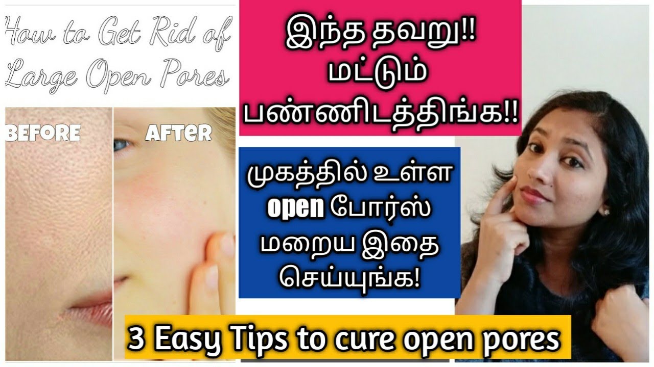 Open Pores HomeremedyAcne Scars Controlமுகத்தில்உள்ள பள்ளங்கள் நீங்க Home remedyTamil
