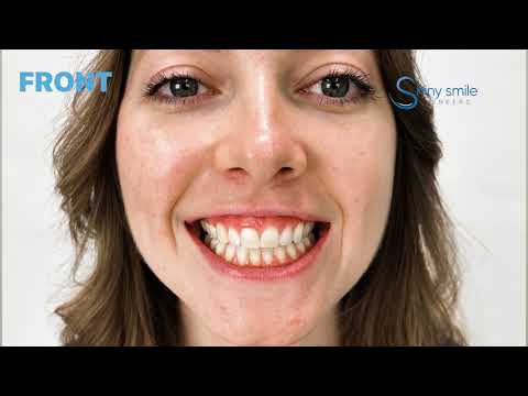 Shiny Smile Veneers Instructional Video How Make The Perfect Teeth Molds At Home 