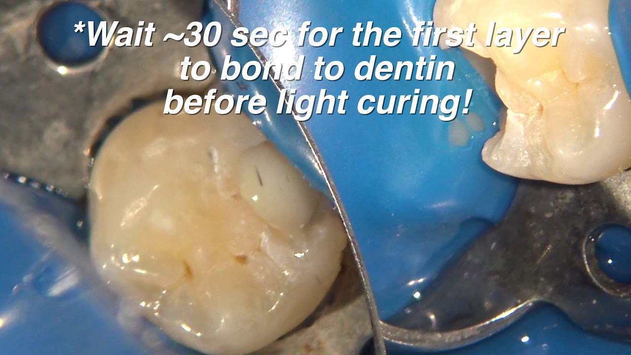 BC Liner for Direct Pulp Capping (part 3 of 8) YouTube