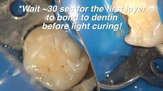 BC Liner for Direct Pulp Capping (part 3 of 8)