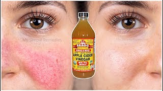 How To Remove Eczema, Blemishes, Acne Marks &amp; Age Spots (100% Effective) Tested Proven Way