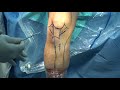 Arthroscopic anterior cruciate ligament acl reconstruction part 1 of 4  dr mihir patel mumbai