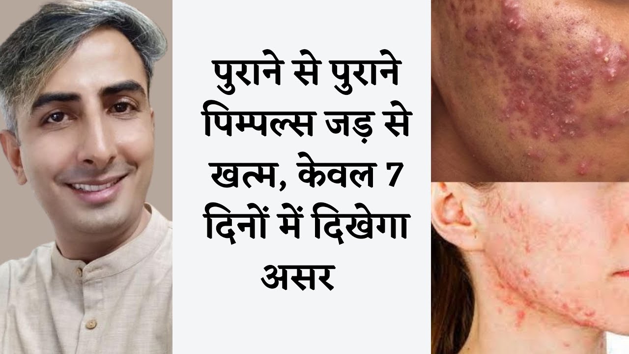 पुराने से पुराने पिम्पल्स जड़ से ख़त्म I GET RID OF PIMPLES AND ACNE PERMANANTLY | DR. MANOJ DAS
