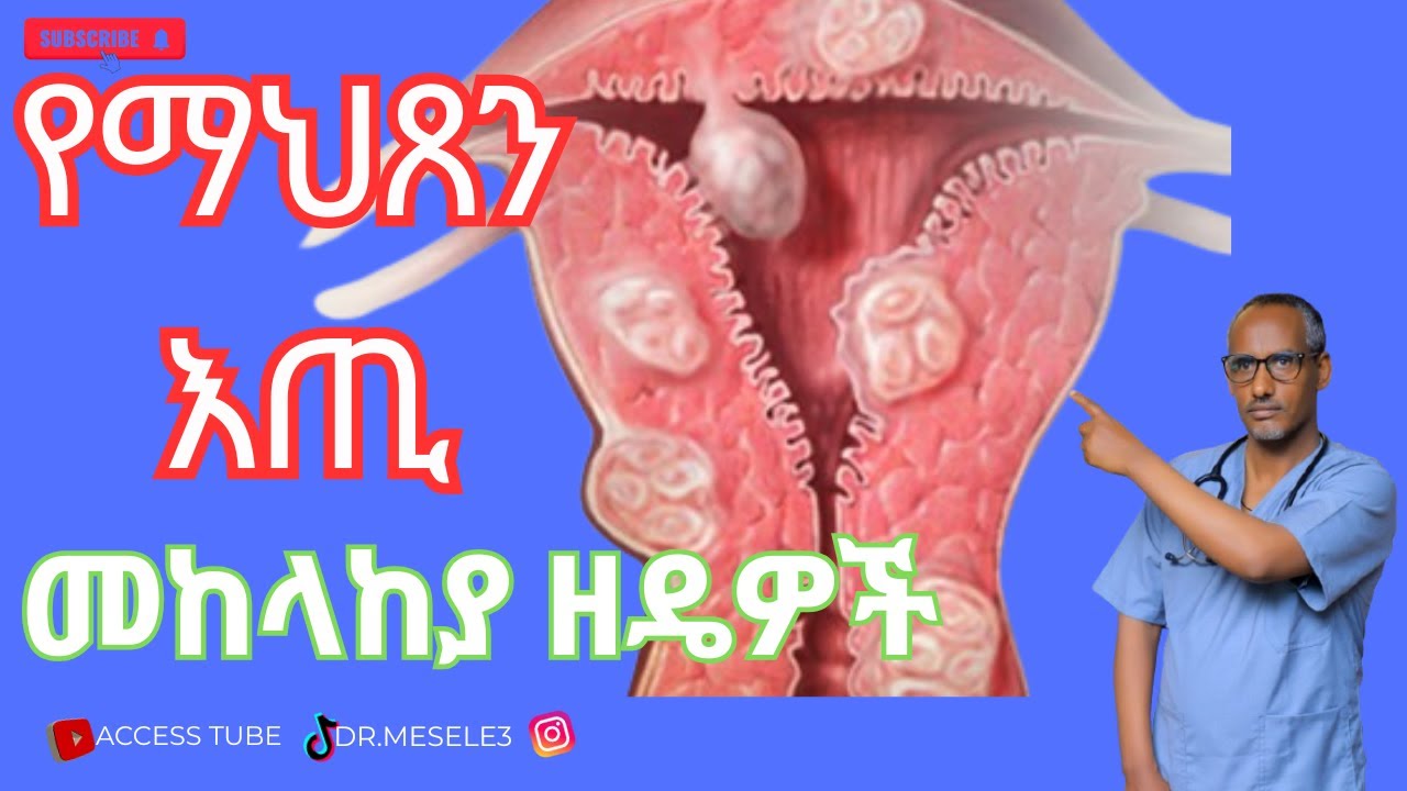 ሞኝ የማህጽን እጢ/Fibroid/ አጋላጭ ምክንያቶች፤ ምልክቶችና የህክምና አማራጮች