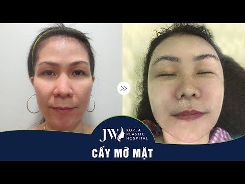 Video Chỉ sau 1 lần cấy mỡ mặt nữ doanh nhân trở về thanh... - youtube
