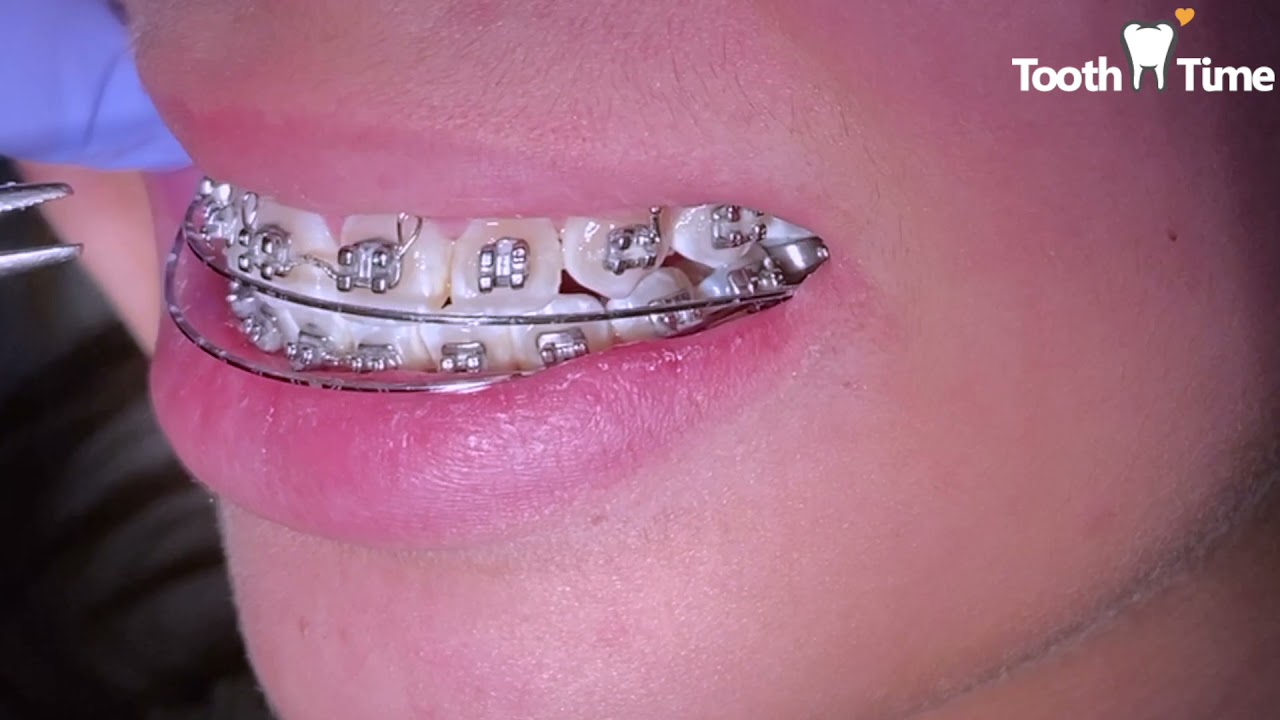 Braces Check ups - Finishing wire - 1 year 4 months with braces