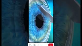 Eye surgery tips #shortvideo #health