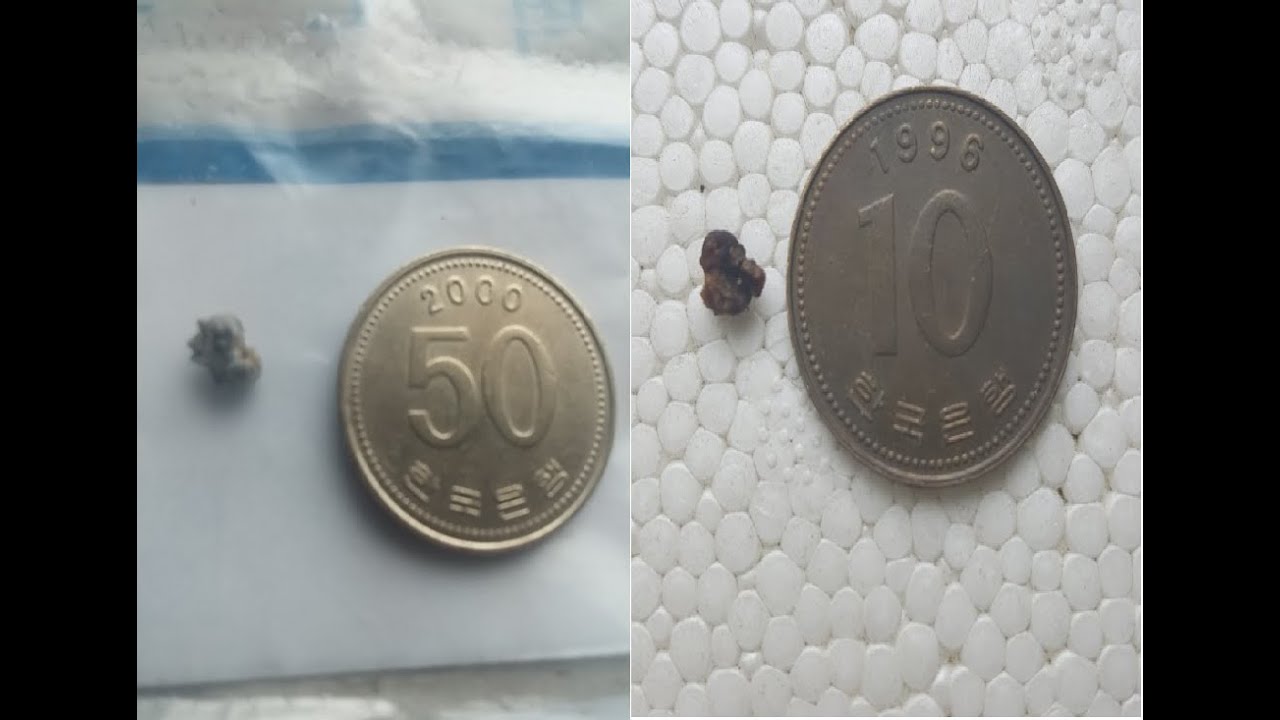 실제 요로결석 환자가 말하고 보여주는 요로결석