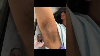 Laser Hair Removal Burn in Dark Skin woman