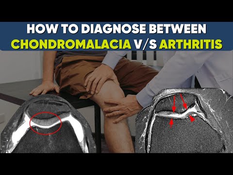 Chondromalacia vs Osteoarthritis of knee-what’s the difference? #drpankajwalecha