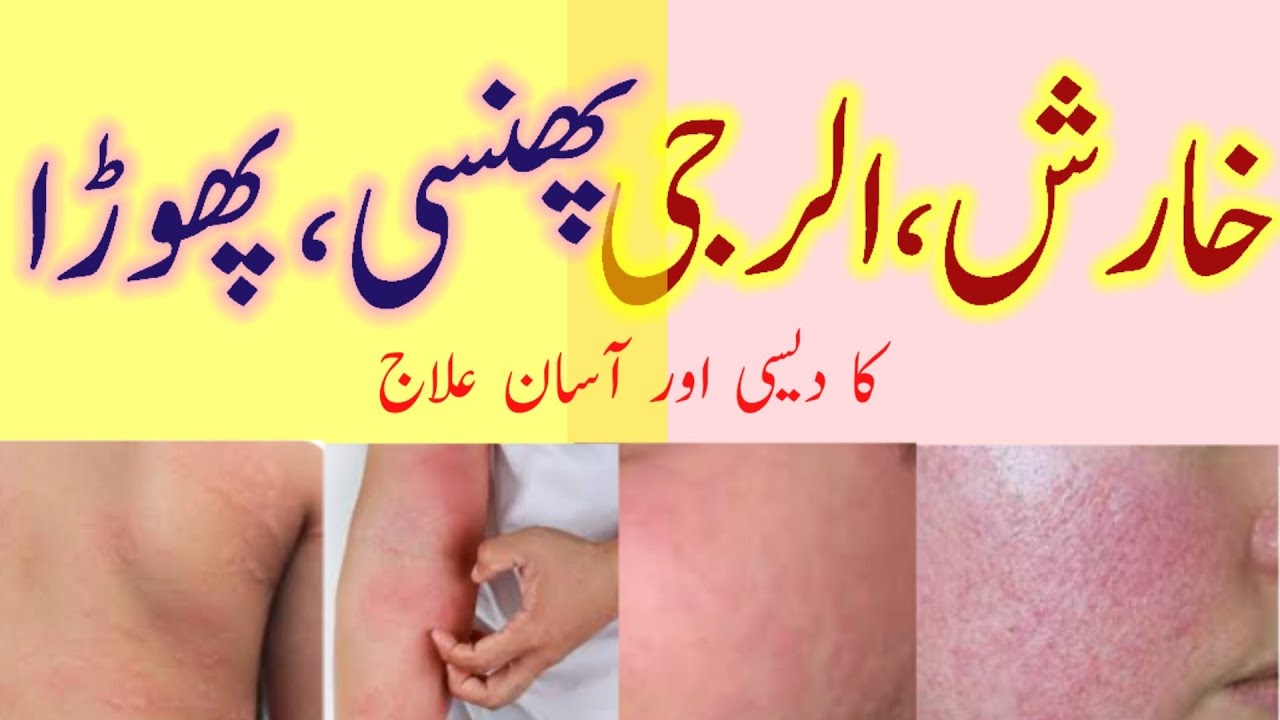 Kharish Allergy Phunsi Phora Ka Desi Aur Asaan Ilaj Itching 