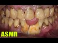 Put An End To hidden tartar large Piece of Tartar was Removed | DON&#39;T LET TARTAR COVER YOUR TEETH