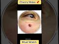 Cherry Cherry 🍒 Moles 🧟♀ #skincare #shorts #health #healthylifestyle #viralshorts ##trending