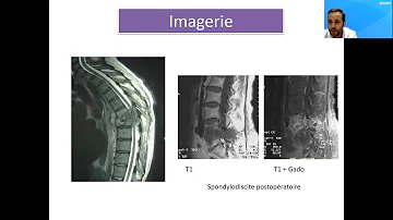 Qu'est-ce que la spondylodiscite ?