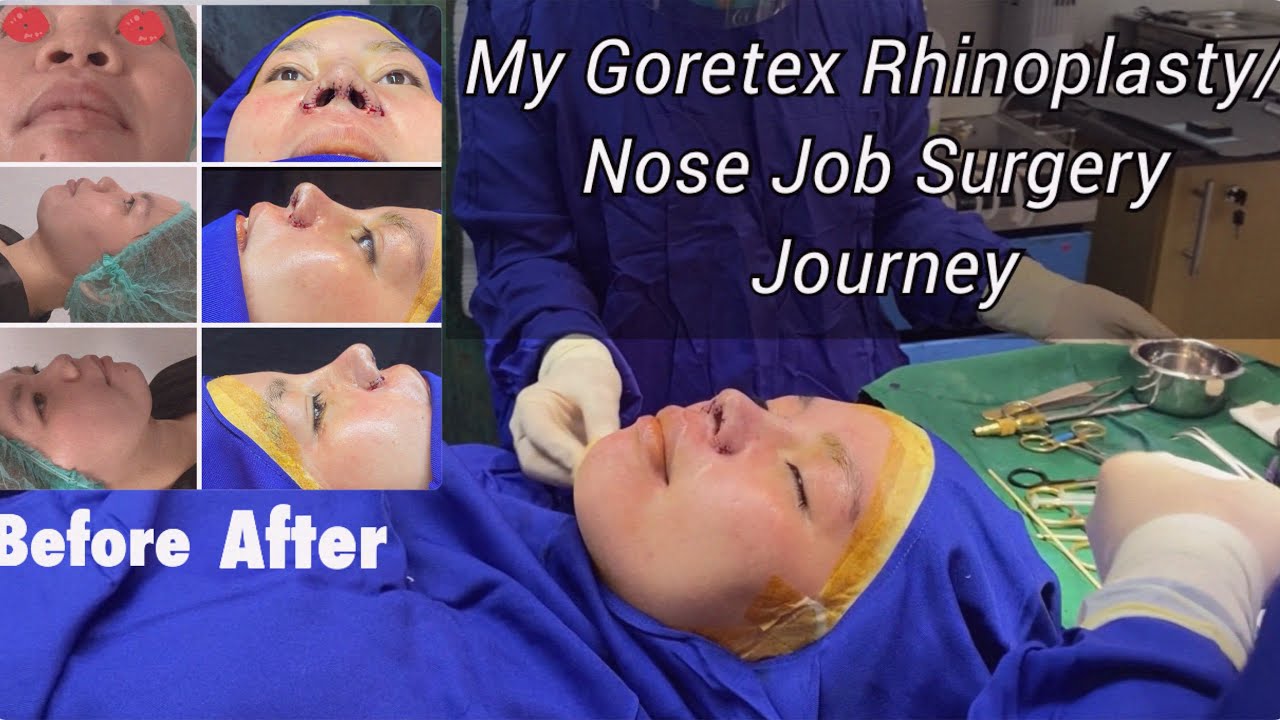 My Goretex Rhinoplasty or Nose Job Surgery Journey YouTube