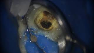 Root canal treatment.   Перелечивание моляра.