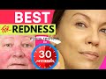 This GETS RID OF REDNESS...in 30 SECONDS!!! ROSACEA, ECZEMA, SENSITIVE SKIN &amp; MELASMA!