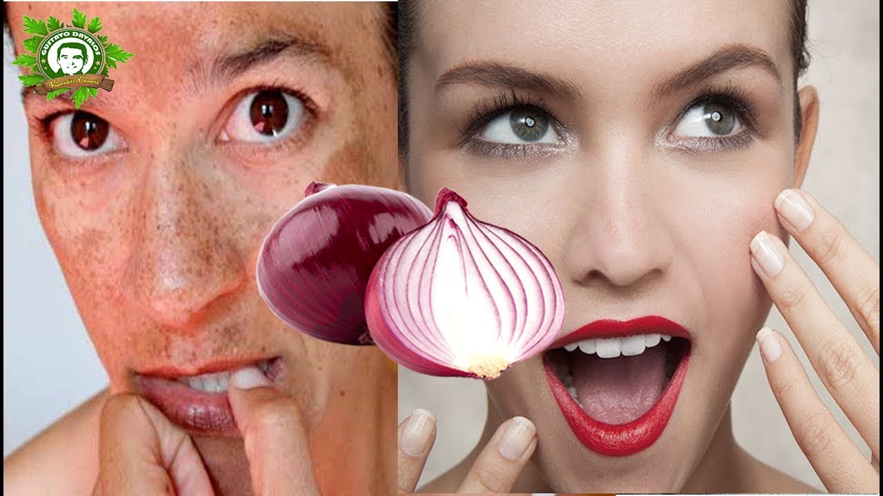 ¿Es Verdad Que la Cebolla Quita las Manchas de la Cara