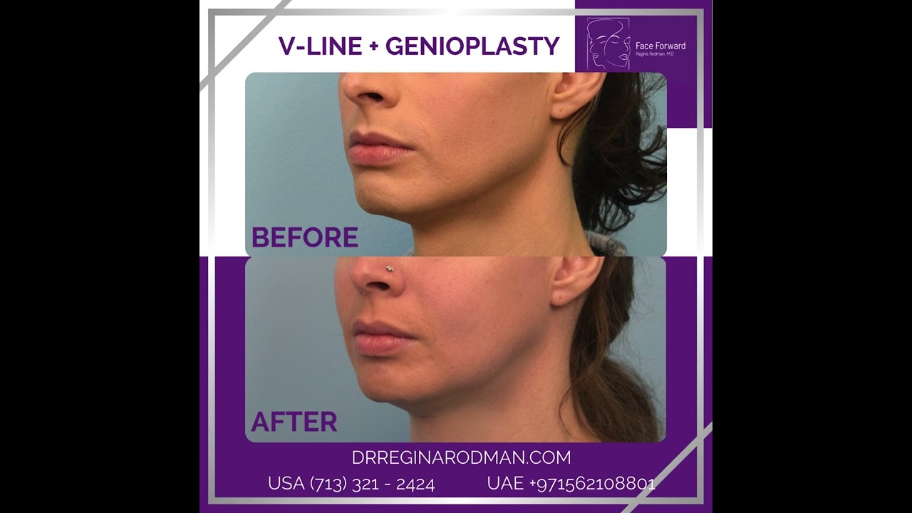 V-Line + Genioplasty