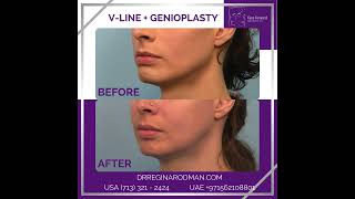 V-Line + Genioplasty screenshot 5