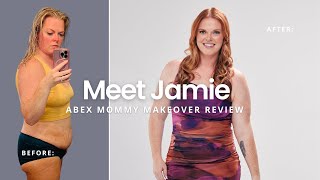 Sono Bello Review: Jamie Regained Confidence After 69 Pound Weight Loss AbEX, Tummy Tuck Alternative