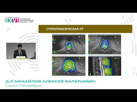 Стереотаксическая лучевая терапия при костных метастазах