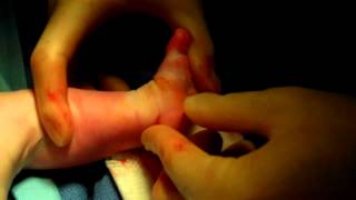 Achilles Tenotomy for Clubfoot Deformity 2 Month Old | Hoosier Foot and Ankle