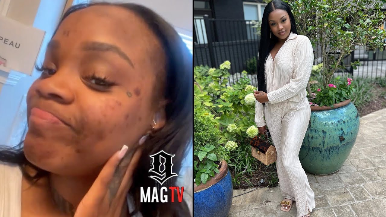 DaBaby's "BM" MeMe Gets A Chemical Peel & Things Go Left! 😱