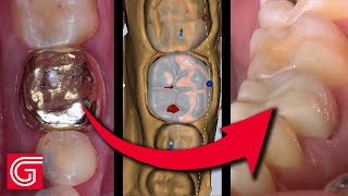 Replacing an Old Gold Crown with BruxZir® NOW in 50 Minutes