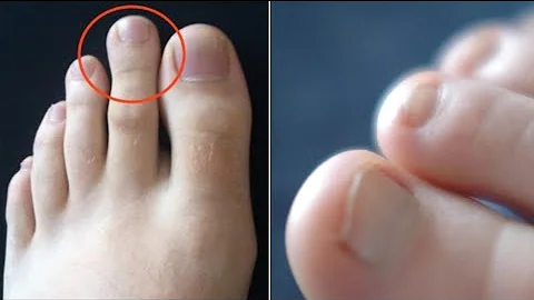 ¿Se supone que el dedo gordo del pie es el más largo?