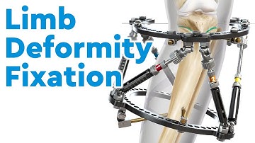 Treatment for Limb Deformities in Children