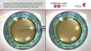 Ziemer Z8 Laser Procedure