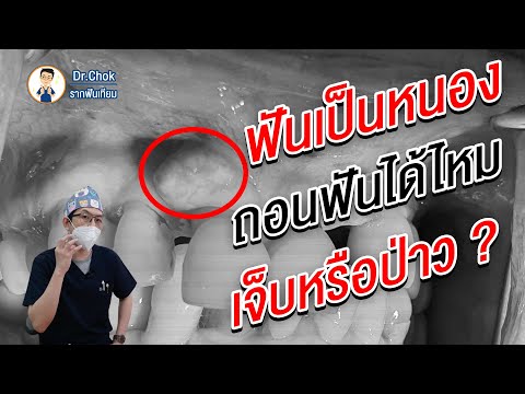 ฟันเป็นหนอง ถอนฟันได้ไหม เจ็บหรือป่าว ?  | คลายปัญหา รากฟันเทียม กับ หมอโชค