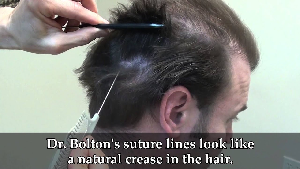 Dr. Brett Bolton Corrective Hair Restoration
