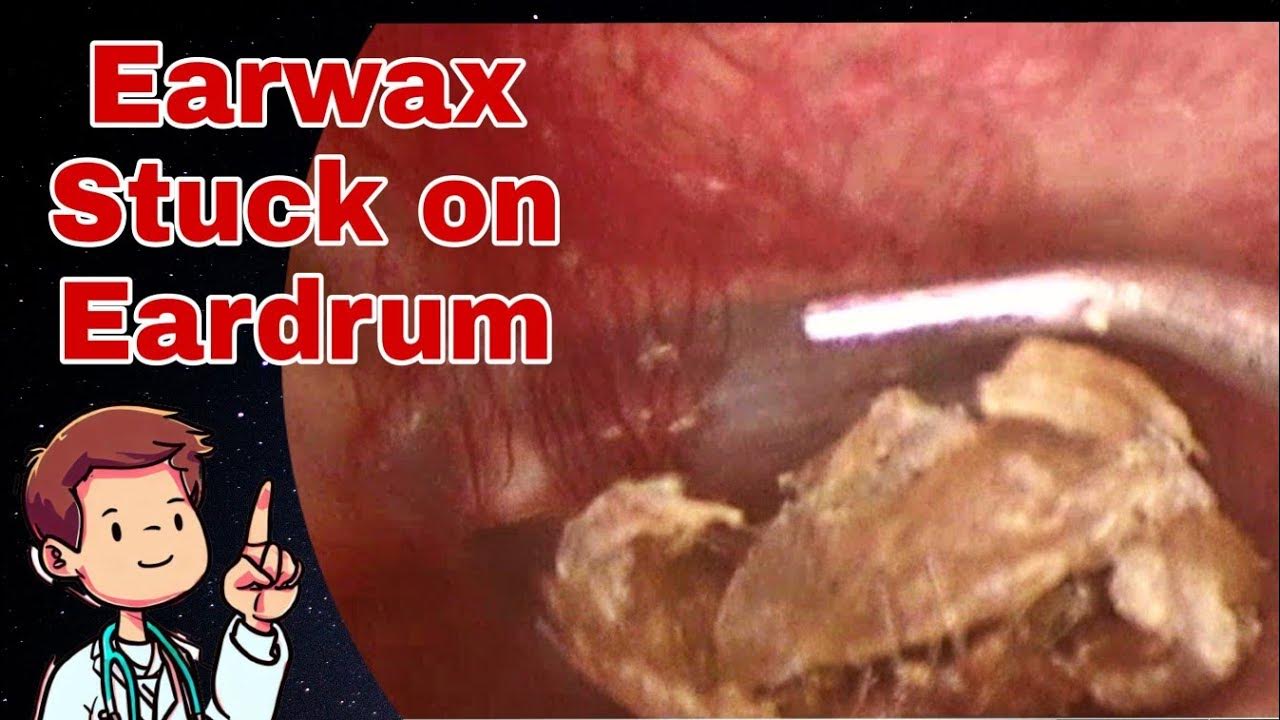 Dry earwax falls inward, causing tinnitus when moving YouTube