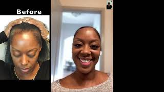 Fort Lauderdale | Hair Transplant for Black Women - Traction Alopecia Hair Loss Solution.